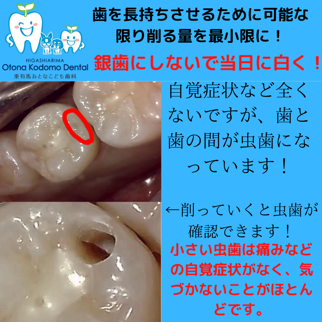 虫歯が手遅れになる前にお伝えしたいこと！！ - 川崎市宮前区の歯医者